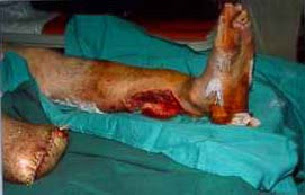 Tratado de pie diabetico | MedWebstudents