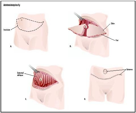 Tummy Tuck Procedure