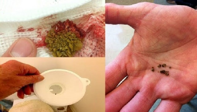 Get Rid Of Kidney Stones Fast With This Simple Home Remedy!