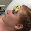 Melanoma Skin Cancer Red Moles : Skin Cancer Types | Basal Cell Carcinoma (BCC) | Squamous - In the united states, it’s estimated that doctors diagnose over 100,000 new skin cancer cases each year.