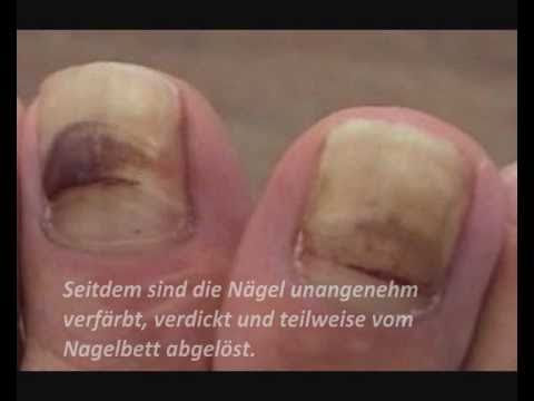 Nagelpilz Folgen sind gelbe, dicke Fußnägel. Was tun? Das spezielle