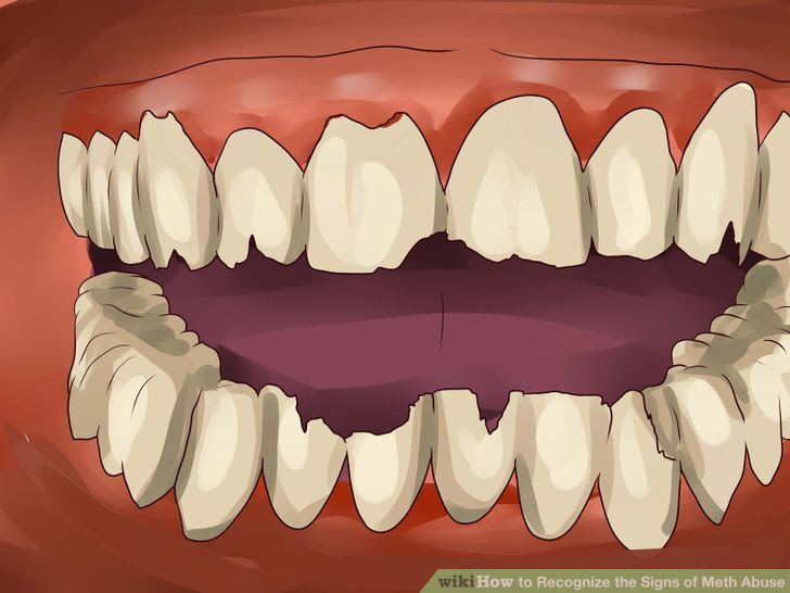 Recognize the Signs of Meth Abuse Step 8.jpg