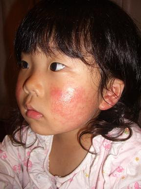 ウィルス性の湿疹 大空へ向かって 楽天ブログ