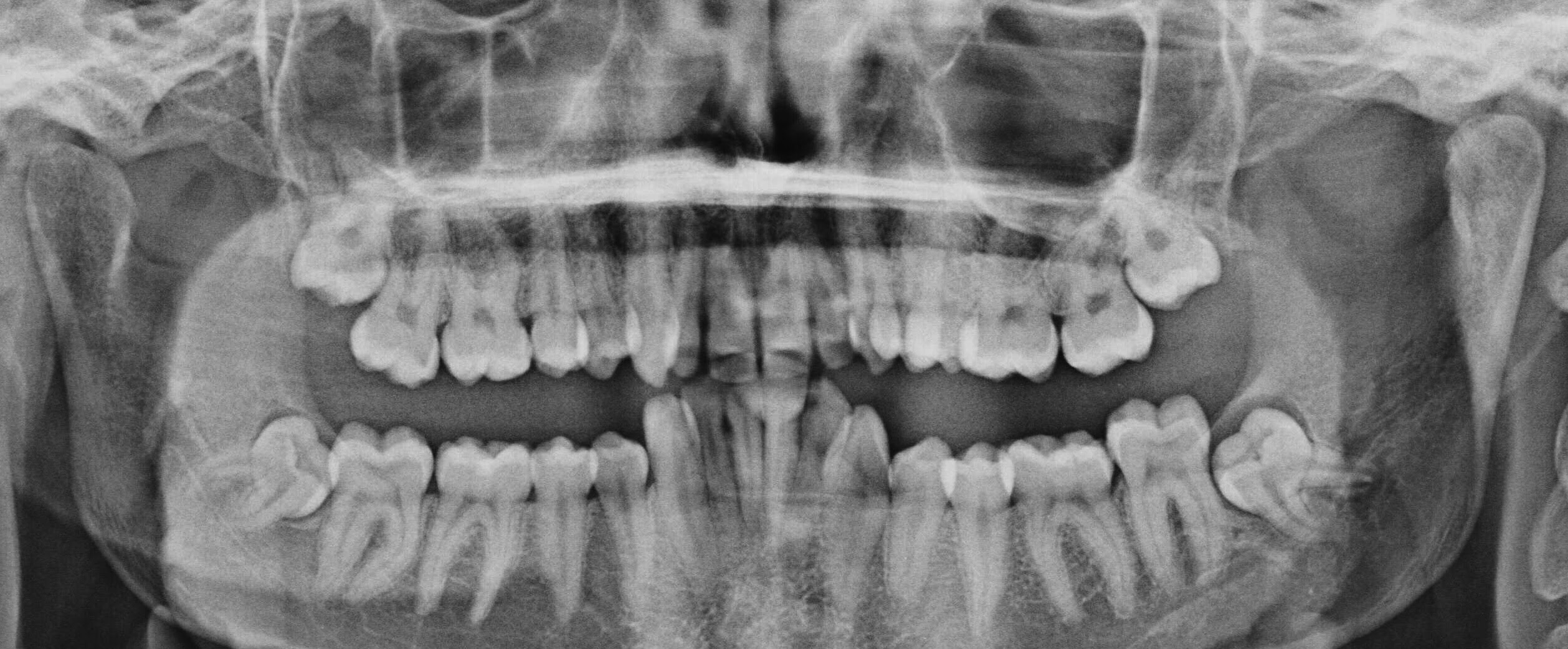 Wisdom Teeth Hobart Orofacial Pain And Special Needs Clinic