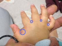 指にできたボツボツ湿疹 鈑金塗装屋の親バカ育児日記