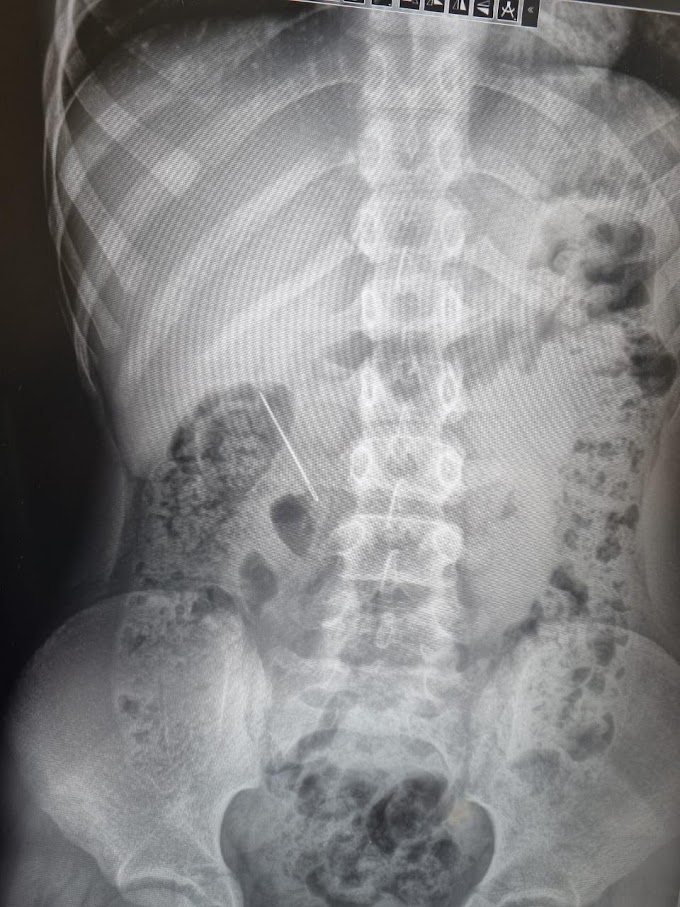 В течение месяца охинские врачи спасли двух детей, проглотивших острые предметы