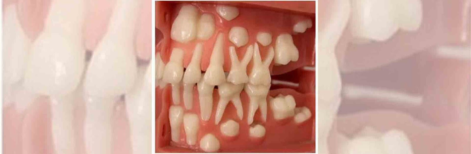permanent tooth filling at home
