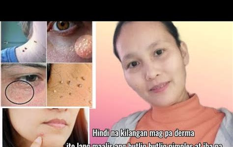 Butlig sa Leeg: Mga Sanhi, Sintomas, at Lunas para Maibsan ang Sakit