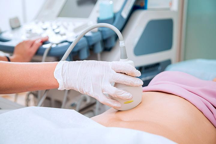 Subchorionic Hematoma