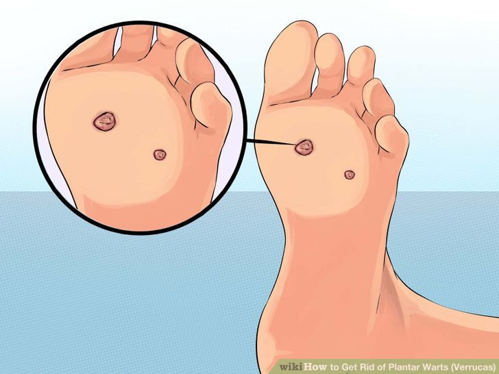 Get Rid of Plantar Warts (Verrucas) Step 13.jpg