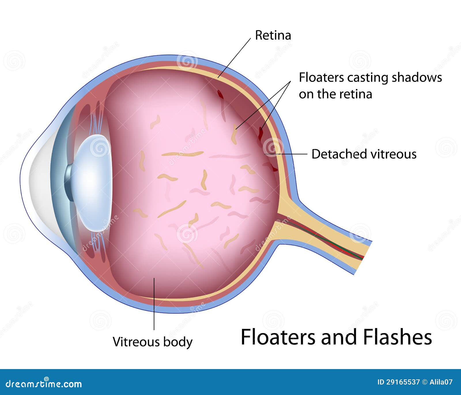 Eye Drops For Floaters Related Keywords &amp; Suggestions - Eye Drops For 