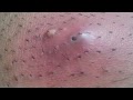 Hair Bumps In Pubic Area