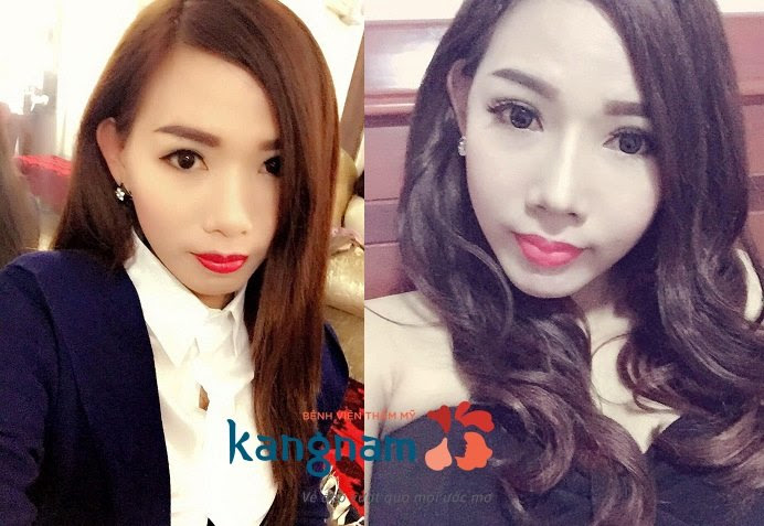 Cắt khóe mắt bao nhiêu tiền2?