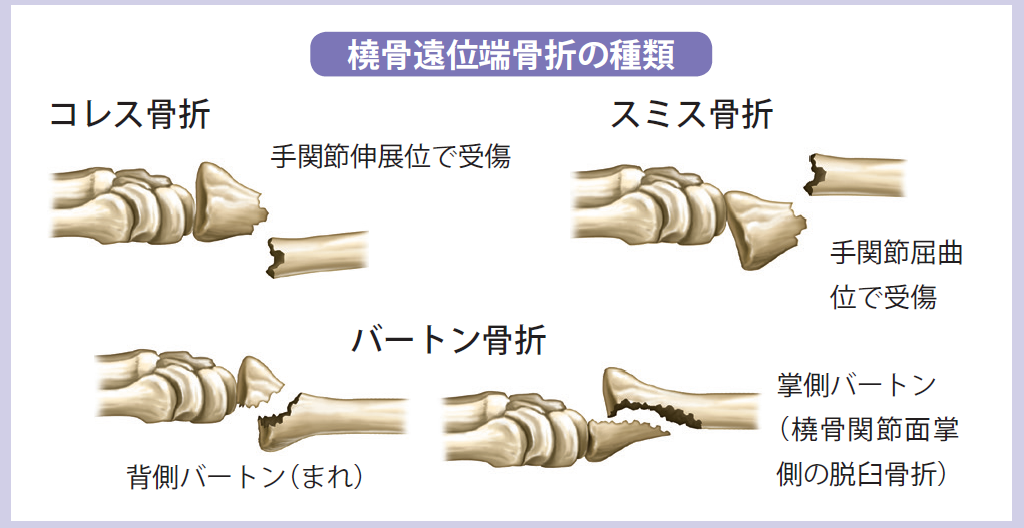 骨折 米内竜の迷走録