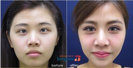 thẩm mỹ mắt to ở đâu đẹp nhất 4