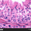 Pleural Mesothelioma Deutsch / Medienberichte und Stellungnahmen - Meistens kommt es in der pleura (pleuramesotheliom), dem herzbeutel und dem peritoneum sowie an der tunica .