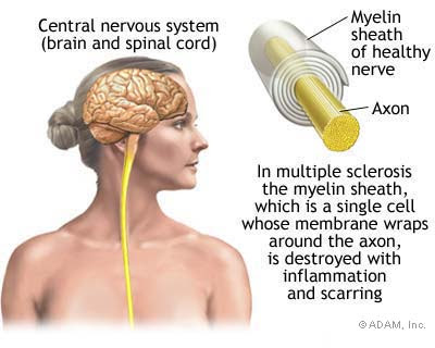 Resultado de imagen de Multiple sclerosis