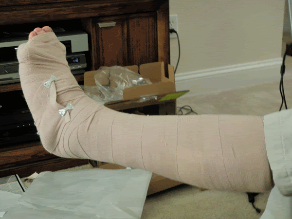 length of pain from broken fibula tibula. fibula fracture protocol. angio fibulation. a fibulation. healing times for tibia fibula growth plate fractures