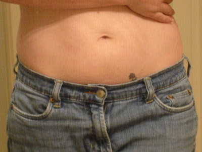 Tattooing Over Stretch Marks. Tattoo Over Stretch Marks
