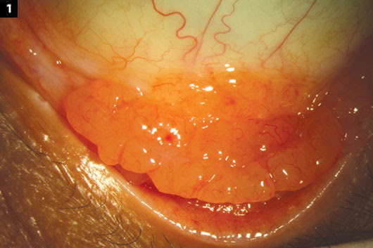 Cutaneous T-cell lymphoma - Symptoms and causes - Mayo Clinic