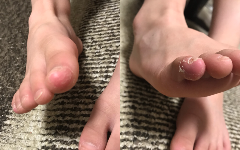 子供の指が脱皮 汗疱状湿疹 かんぽうじょうしっしん とは 株式会社アーツ