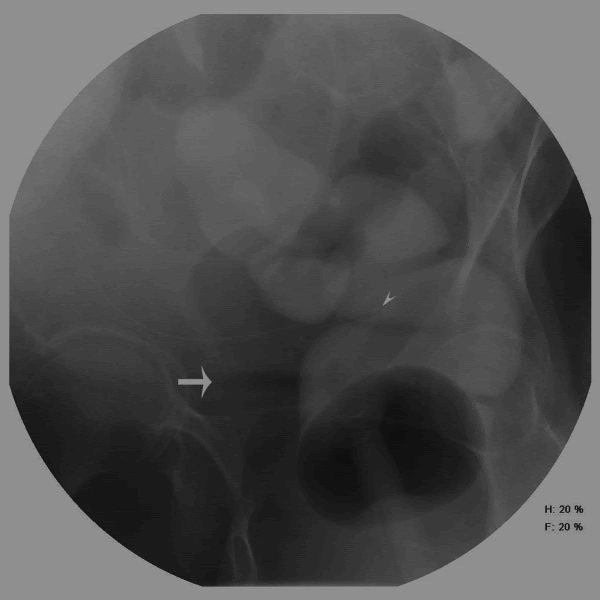 Peritoneal dialysis catheter