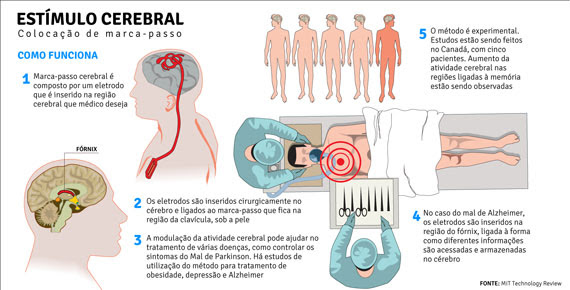 aIfwiol Vídeo impressionante: paciente liga e desliga doença de Parkinson