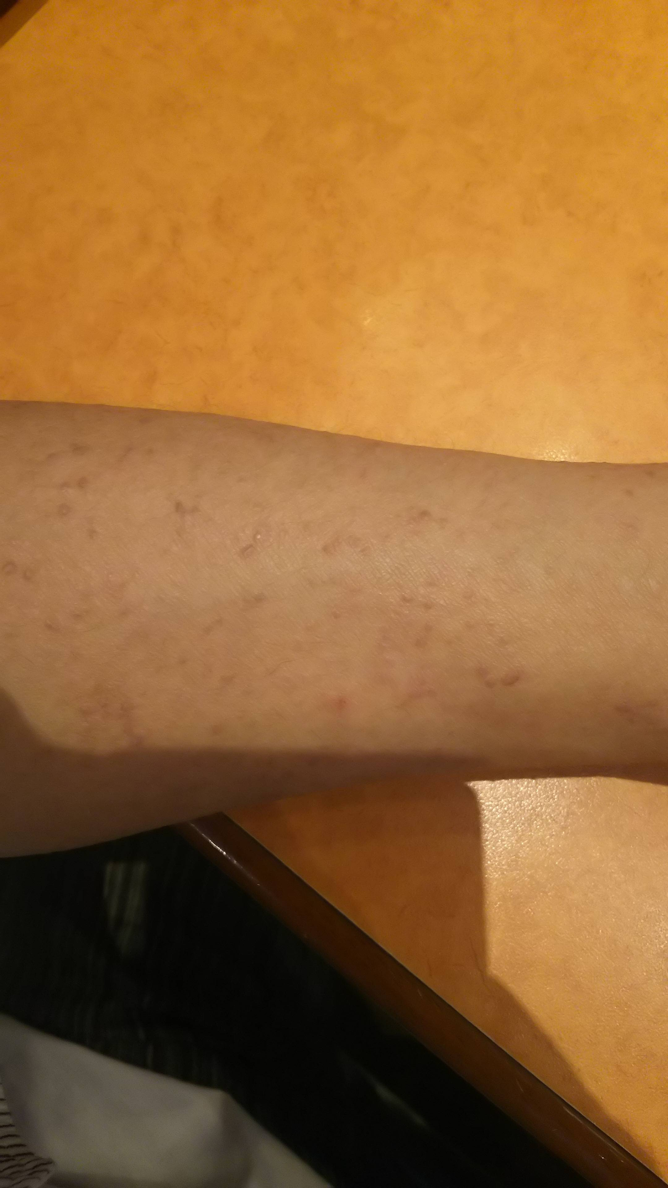 心と身体 アミロイド苔癬 2 びんたんde５ちゃんねる