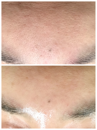 剥離しない痛くない漢方ハーブピーリング 交野市 枚方市 寝屋川市 京田辺市 まつげパーマ 全身脱毛 メンズヒゲ脱毛 Sally 内川恵美