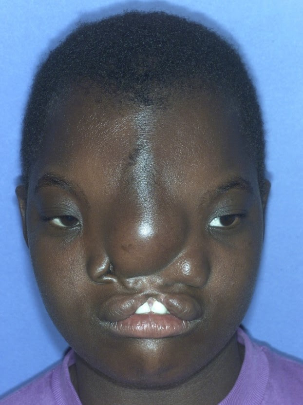 Les Mutilations Du Visage A E M V