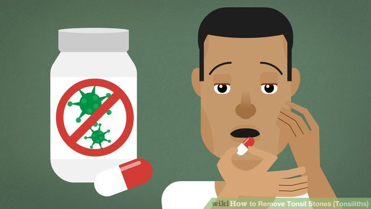 Remove Tonsil Stones (Tonsiliths) Step 1 Version 3.jpg