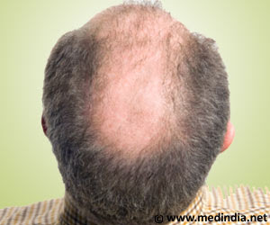 US Researchers Invent New Hair Restoration Method to Beat Hair Loss