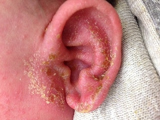 アトピー性皮膚炎