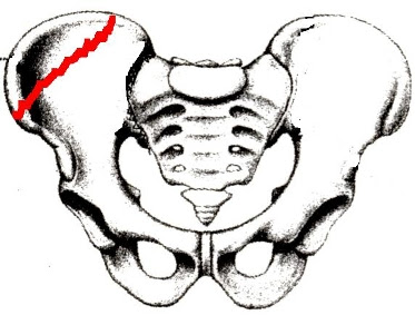 骨盤骨折とは 骨盤内腔には尿道や膀胱などの泌尿器系の内臓があり 場合によっては命に関わる重篤な骨折です 大きく分けて 単独骨折 と 環骨折 があります 骨盤は 前面の恥骨結合 左右の腸骨 後面の仙骨で構成されており 輪になってい