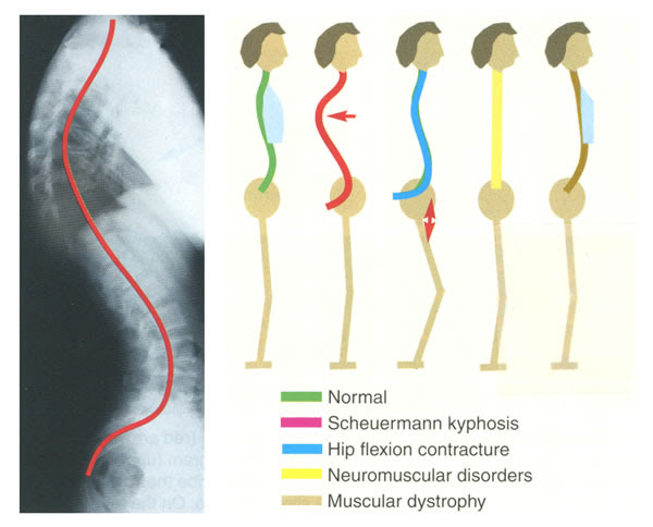 Kyphosis Exercises Definition of kyphosis