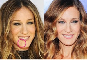Cost of Mole Removal by Plastic Surgeon - Mole Removal
