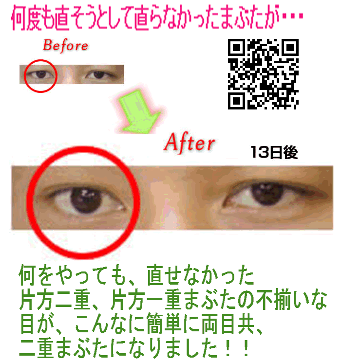 二重手術なしで安全に両目とも二重まぶた No 13 彩式小顔整顔 目力二重まぶた術 手術やアイプチなし簡単二重まぶたを定着方法