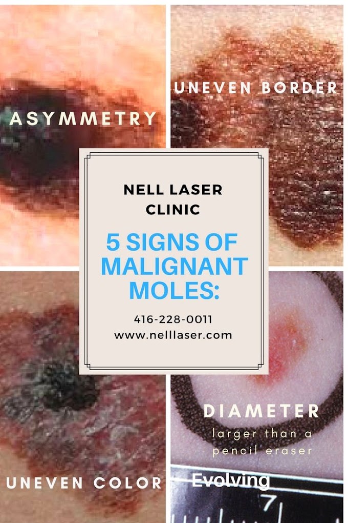 Skin Cancer Mole Black - Skin Cancer victory - Part 3 - Cansema Black Salve - YouTube