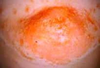 skin rashes guide filled  pictures treatment tips