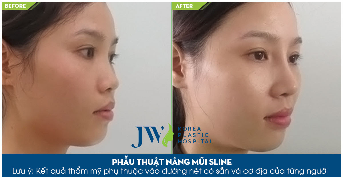 Nâng mũi cấu trúc giá bao nhiêu