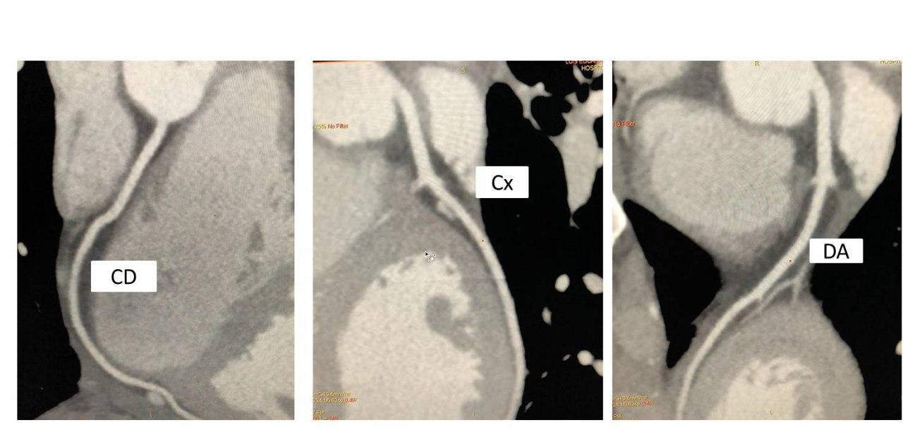 Masculino de 20 años con precordialgia y disnea desde hace 3 semanas atribuibles a miocarditis ...