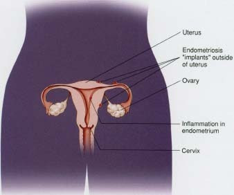 Endometriosis - body, causes, Keyword, What Is Endometriosis?
