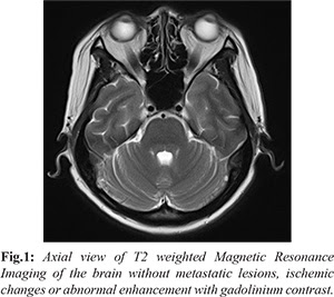Rare Paraneoplastic Opsoclonus Myoclonus Syndrome Poms In A Recurrent Breast Cancer Patient Importance Of Early Recognition Of Poms And Initiation Of Rehabilitation Intervention