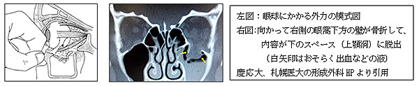 眼窩底骨折 広辻眼科