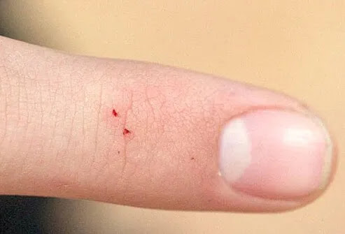 Bad Bugs Pictures Slideshow: Identify Bugs and Their Bites ...