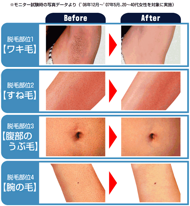 エピクリスタルa A級の永久脱毛剤 自宅でプロのクリニック レーザー脱毛級の効果 簡単永久脱毛クリーム A級の永久脱毛オフィシャルサイト