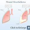 Pleural Mesothelioma Treatment Guidelines / Qiao's Pathology: Malignant Pleural Effusion with Metastat - Data supporting treatment recommendations are derived from observational studies.