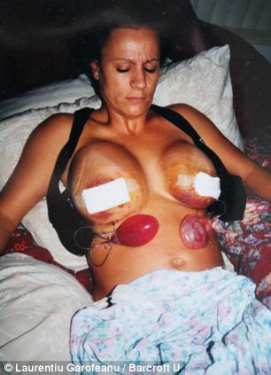 Lacey Wildd after surgery with breast size 800CC in 2001