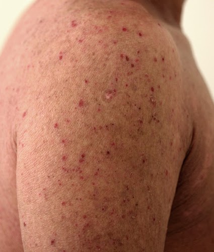 カポジ 水痘 様 発疹 症 写真 - クロフィブラート軟膏u2015ケース
５，７，８のその後、および軟膏作成法