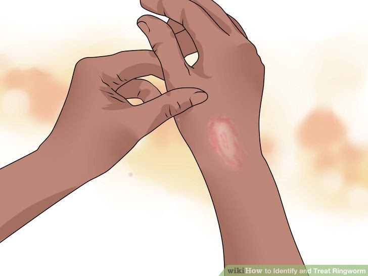 Identify and Treat Ringworm Step 4 Version 2.jpg